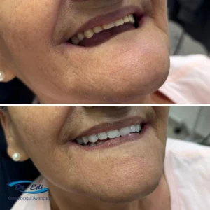 Implantes dentários