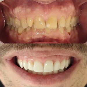 Facetas e coroas