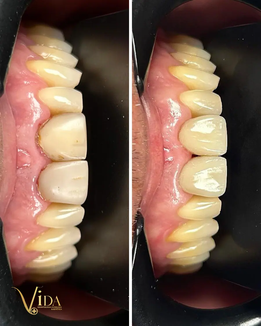 Facetas em resina - caso 13