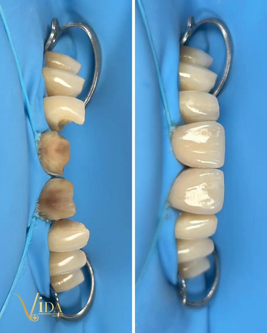 Facetas em resina - caso 19