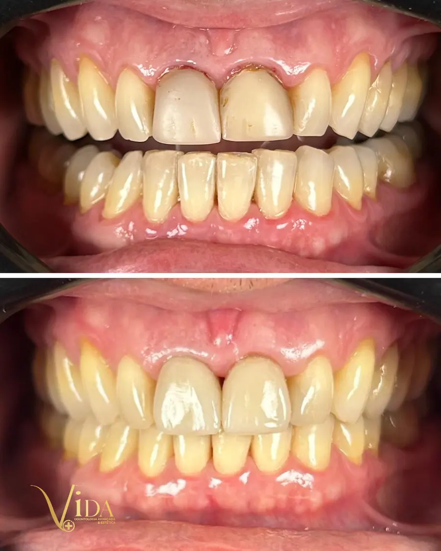 Facetas em resina - caso 20