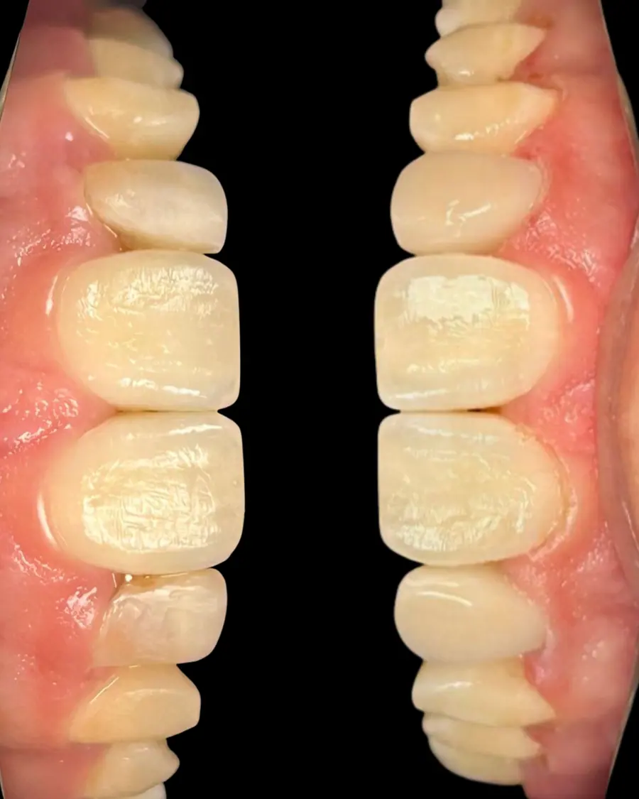 Facetas em resina - caso 25