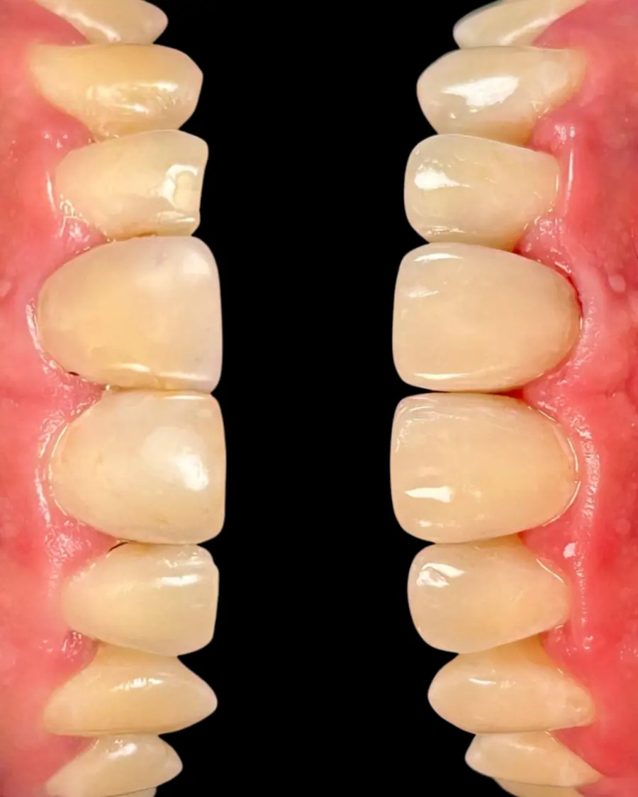 Facetas em resina - caso 26