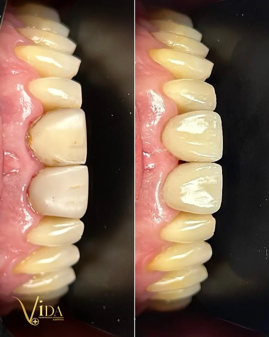 Facetas em resina - caso 29