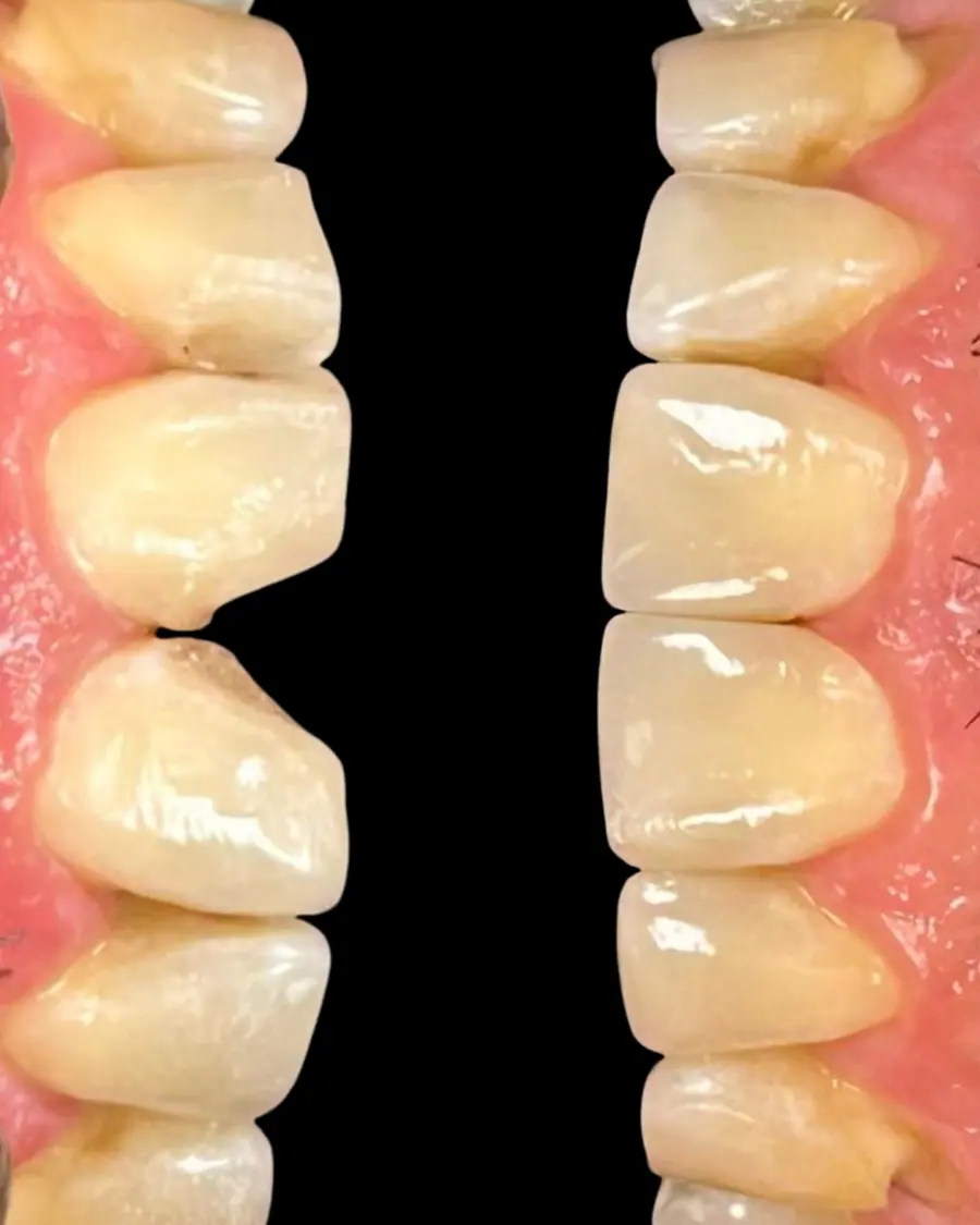 Facetas em resina - caso 41