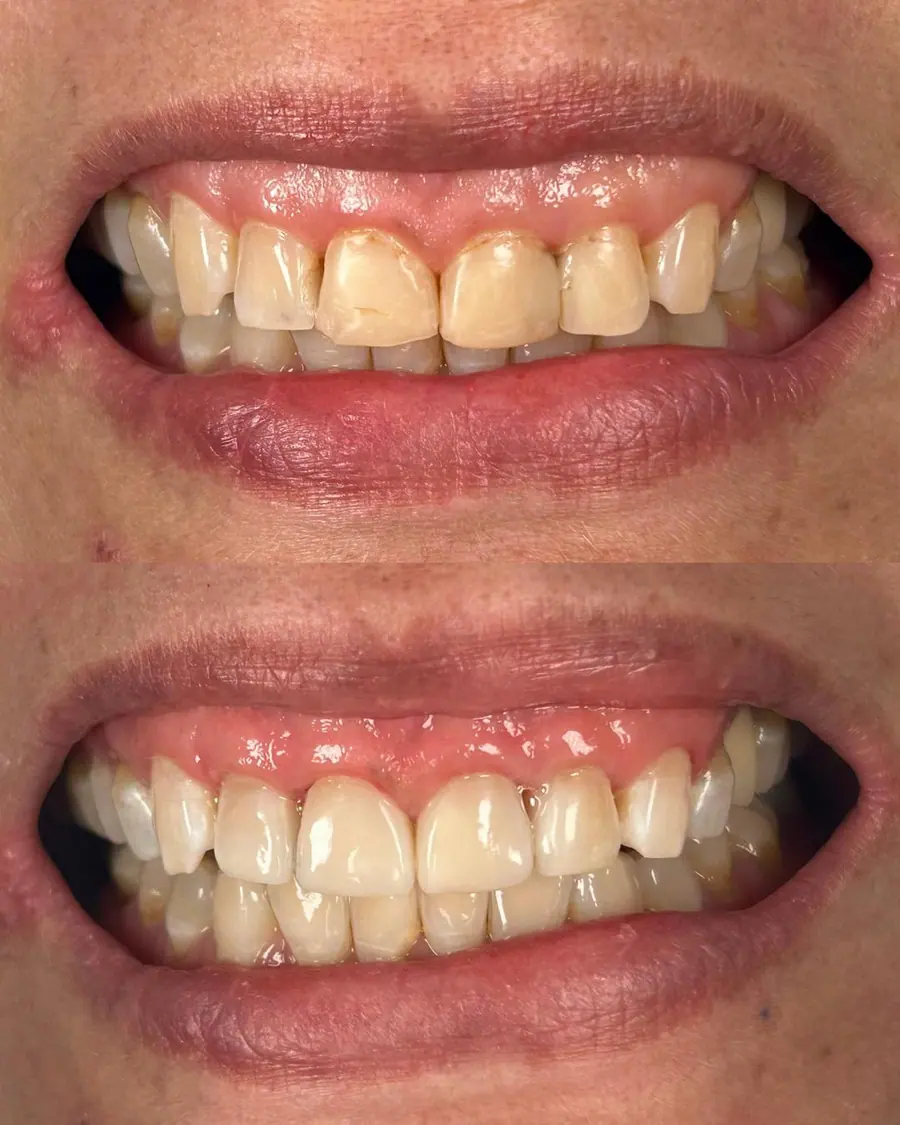 Facetas em resina - caso 50