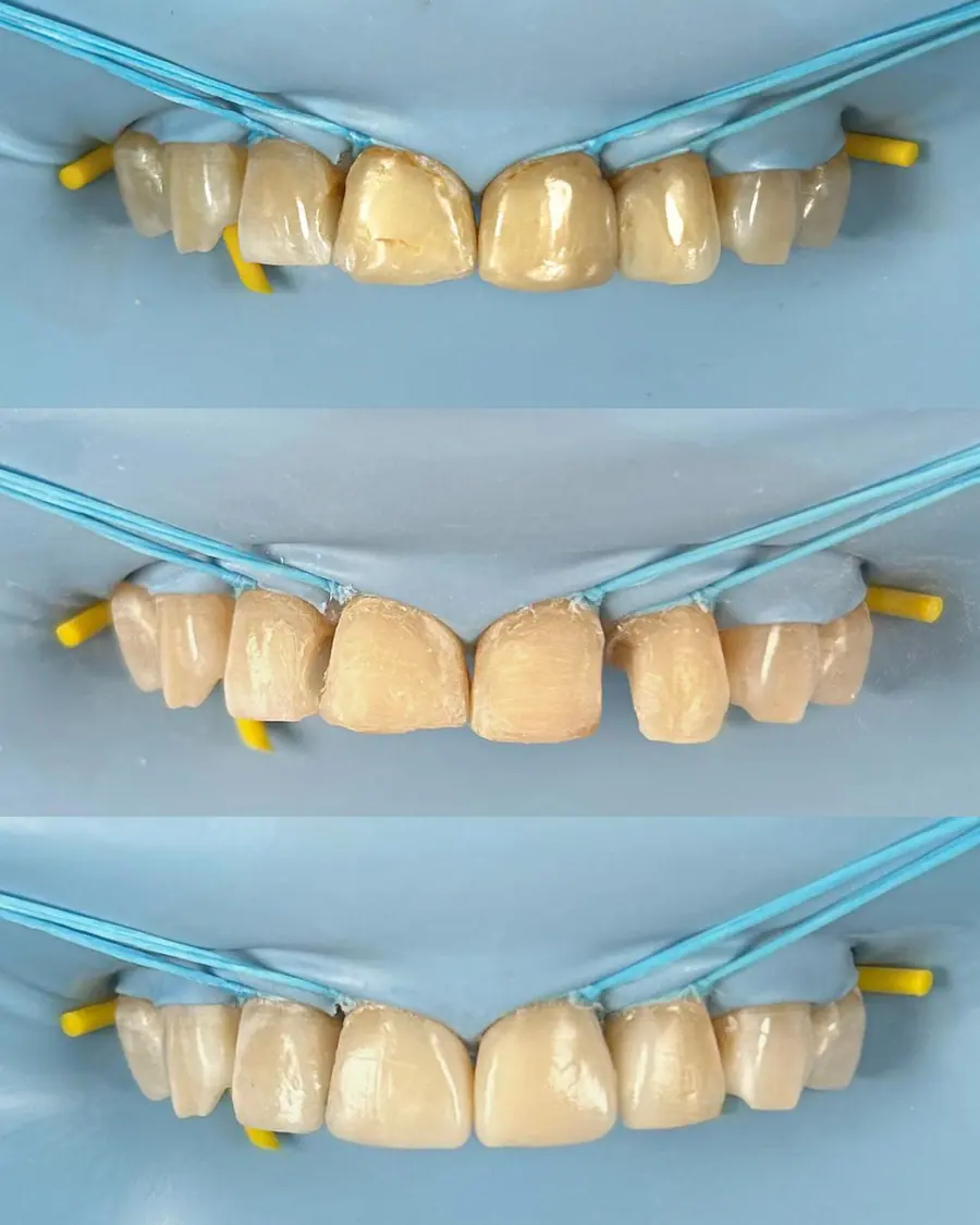 Facetas em resina - caso 51